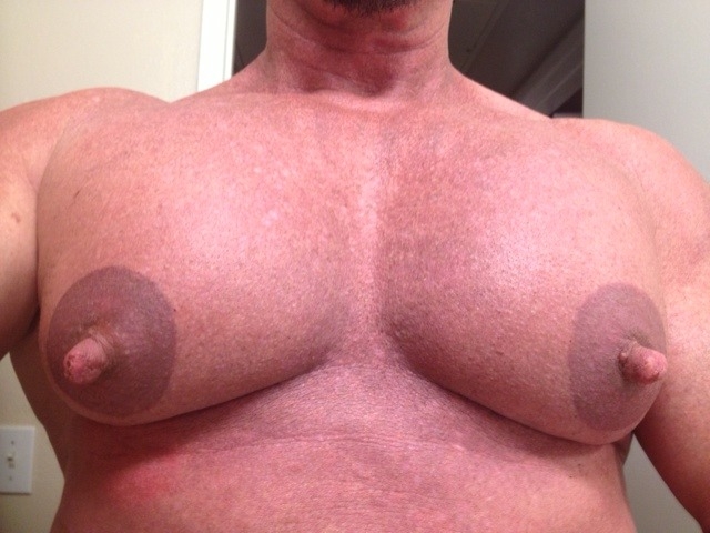 Men with female breasts