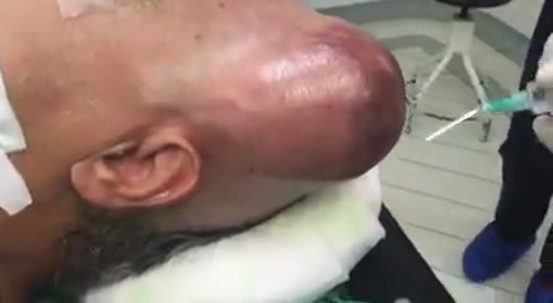 Successful Brain Transplant