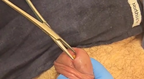 Giving Birth To A Kidney Stone